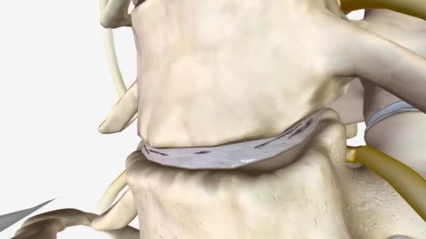 子宮頸部変性円盤疾患 3D医療 — ストック動画