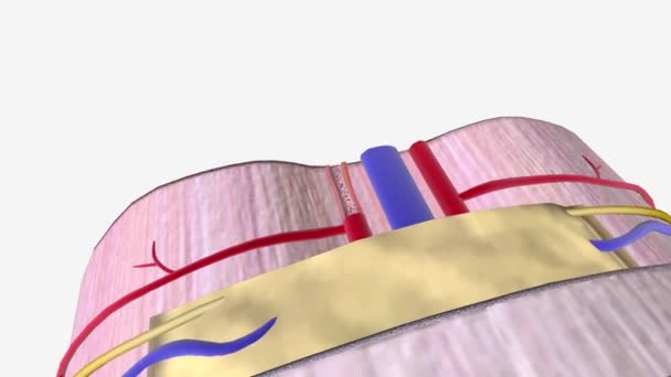 Atherosclerosis Plaque Buildup Walls Arteries — Stock video