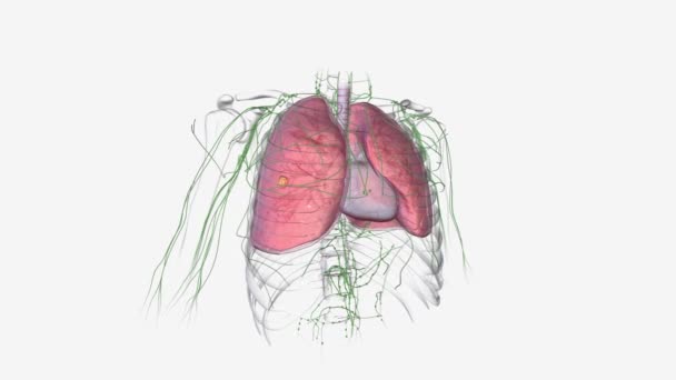Bronşiektazi Akciğerlerin Hava Yollarının Genişlediği Akciğerleri Enfeksiyona Karşı Daha Savunmasız — Stok video