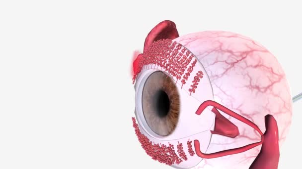 Chalazion Göz Kapağındaki Yağ Bezinin Tıkanması Şişmesi Sonucu Oluşan Yavaş — Stok video