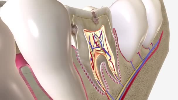 Hohlräume Sind Dauerhaft Geschädigte Bereiche Der Harten Zahnoberfläche Die Sich — Stockvideo