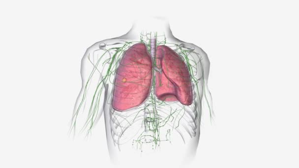 支气管扩张是一种长期的情况 在这种情况下 肺的气道会扩大 导致多余的粘液堆积 使肺更容易感染 — 图库视频影像