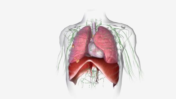 Cancro Polmoni Raggiunge Fase Diffuso Dai Polmoni Altri Tessuti Vicini — Video Stock