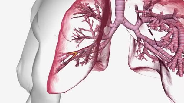 Бронхиэктаз Является Долгосрочным Состоянием Дыхательные Пути Легких Расширяются Приводит Накоплению — стоковое видео