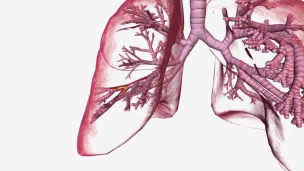 Bronchiektázie Dlouhodobý Stav Kdy Dýchací Cesty Plic Rozšíří Což Vede — Stock video