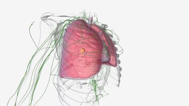 一级肺癌是一种小肿瘤 尚未扩散到任何淋巴结 — 图库视频影像