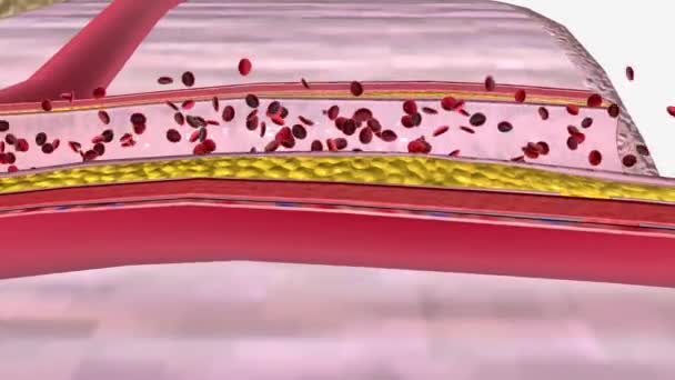Atherosclerosis Progression Penis Plaque — Stock Video