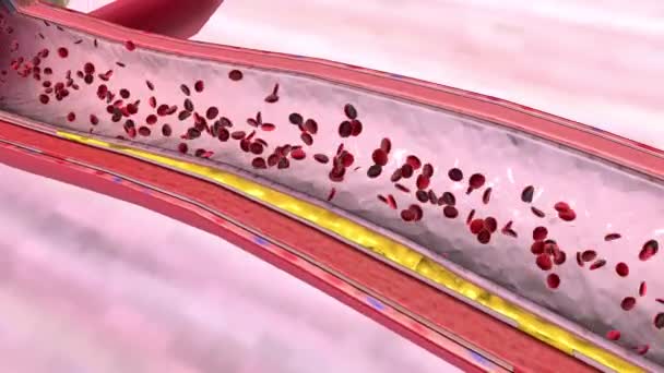 Ateroskleroz Belirli Bir Arterioskleroz Türüdür — Stok video