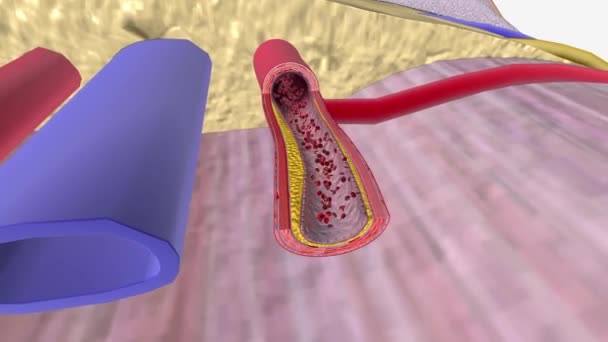 Atherosclerosis Progression Penis — Stok video
