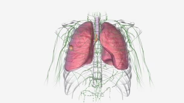 ステージ2A肺癌では 腫瘍は4 Cmから5 Cmとリンパ節の間で測定されます — ストック動画