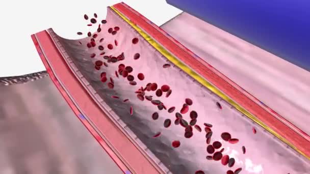Atherosklerose Ist Eine Spezifische Form Der Arteriosklerose — Stockvideo