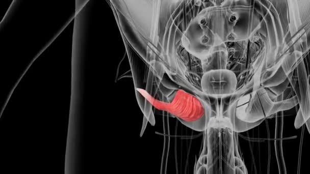 阻塞器外植入物 股骨大转子的后子宫表面 — 图库视频影像