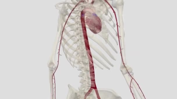Een Abdominale Aorta Aneurysma Een Vergroot Gebied Het Onderste Deel — Stockvideo