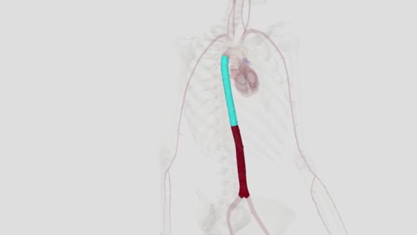Aneurisma Aorta Perut Adalah Daerah Yang Diperbesar Bagian Bawah Arteri — Stok Video