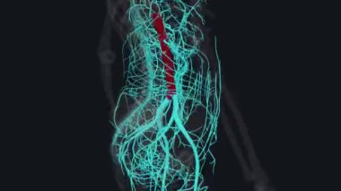 Abdominal aort anevrizması, vücudun ana atardamarının alt kısmında, aort adı verilen genişletilmiş bir alandır.