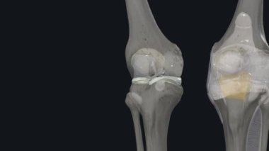Kemikler dizdeki iki tip kıkırdak tarafından korunuyor ve yastıklanıyor: eklem kıkırdağı ve menisküs kıkırdağı. .