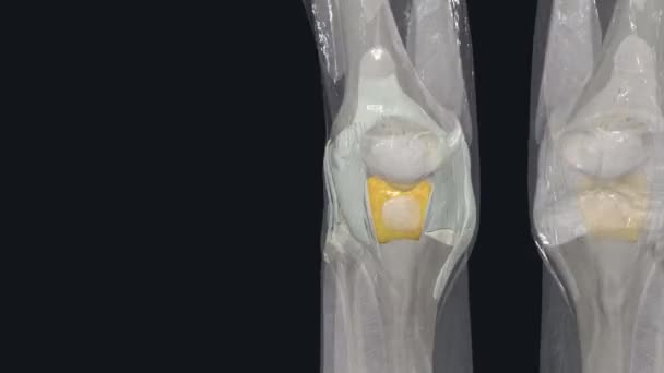 Knee Largest Most Complex Joint Body Holding Together Thigh Bone — Stock Video