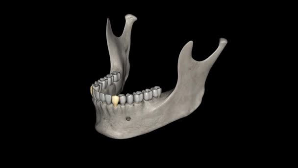 Canino Mandibular Dente Localizado Distalmente Ambos Incisivos Laterais Inferiores Boca — Vídeo de Stock