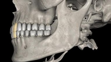 Lateral Incisor, Maxillar ve Mandibular .