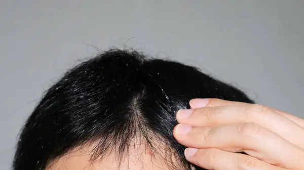 Japanese men suffering from thinning hair