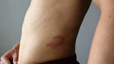 Karnında egzama olan biri.