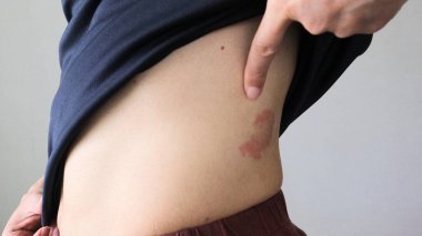 Karnında egzama olan biri.