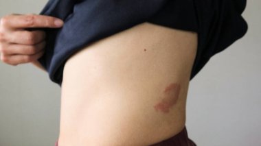 Karnında egzama olan biri.