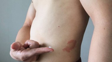 Egzamaya ilaç uygulayan bir kişi