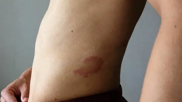 Karnında egzama olan biri.