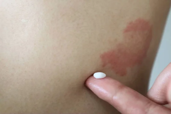 Egzamaya ilaç uygulayan bir kişi