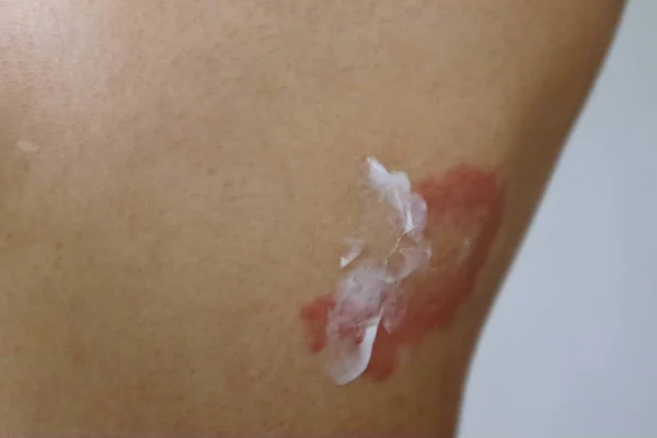 Egzama ve uygulamalı ilaç