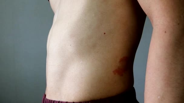 Homem Com Eczema Seu Abdômen — Vídeo de Stock