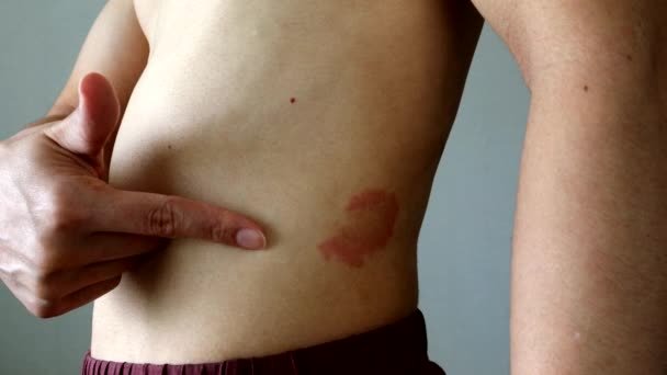 湿疹を指している裸の人 — ストック動画