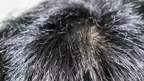 Bir adamın kafa derisine yakın çekim