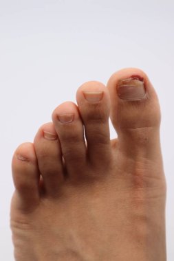 Ayak tırnağı yaralanmış biri.