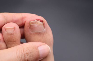 Yaralı başparmak tırnağıyla ayak