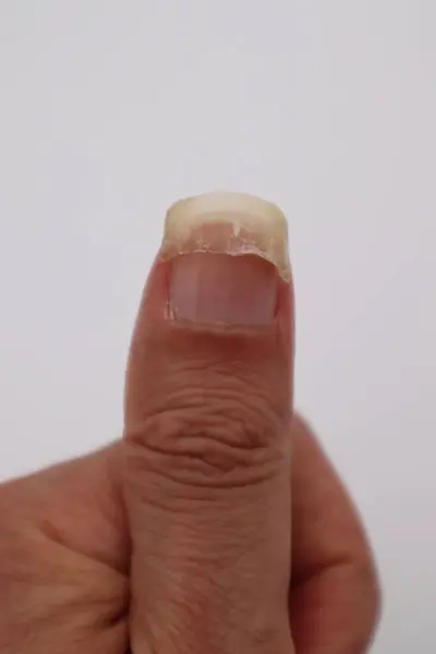 Tırnağı yaralı biri.