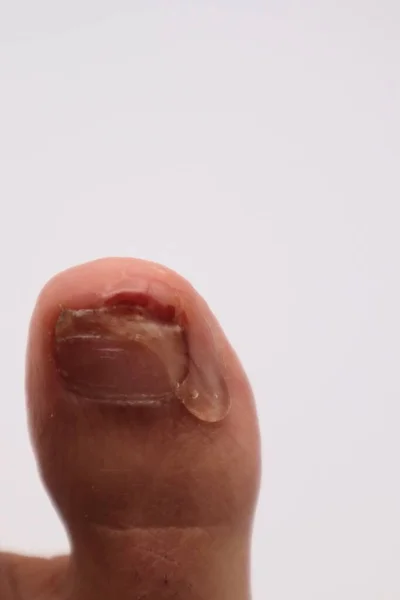 Sıvı yapıştırıcılı tırnaklar.