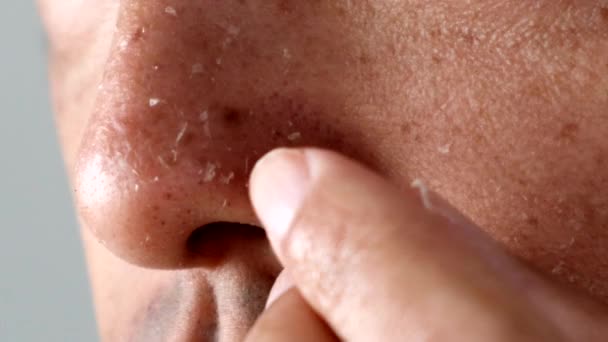 Japanese Man Peels His Sunburned Nose — Stock Video