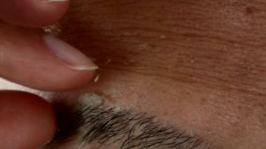 Bronzlaşmış deriyi soyan biri.