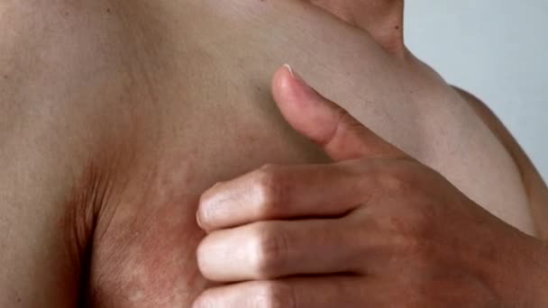 Hombre Japonés Arañando Eczema — Vídeos de Stock