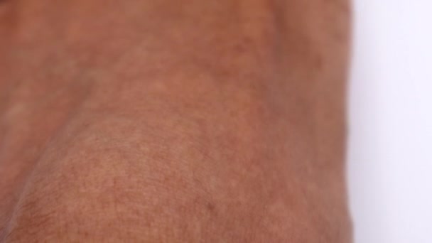 Fußnägel Wurden Durch Verletzung Schwarz — Stockvideo