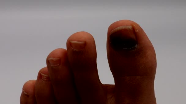 Yaralı Bir Ayak Tırnağını Yakınlaştır — Stok video