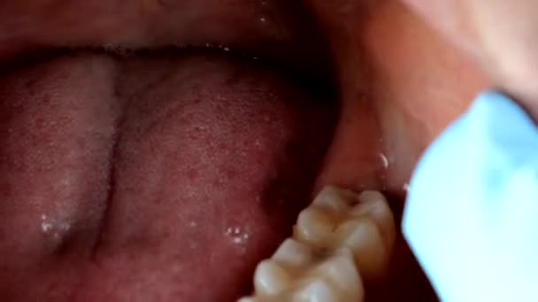 知恵の歯によって引き起こされるガム穴 — ストック動画