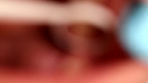 Dziura Dziąsłach Spowodowana Zębami Mądrości — Wideo stockowe