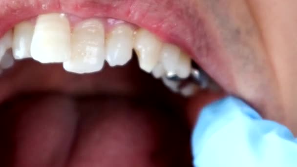 Відео Людини Яка Робить Огляд Зубів — стокове відео