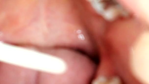 知恵の歯によって引き起こされる歯の穴 — ストック動画