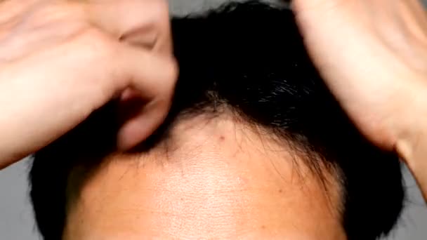 头发稀疏的男人把头发弄好 — 图库视频影像