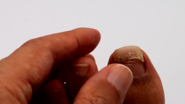 Ένα Άτομο Που Αφαιρεί Ένα Τραυματισμένο Νύχι Ποδιού — Αρχείο Βίντεο