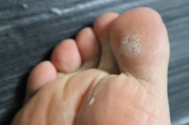 Baş parmağında su toplamış.